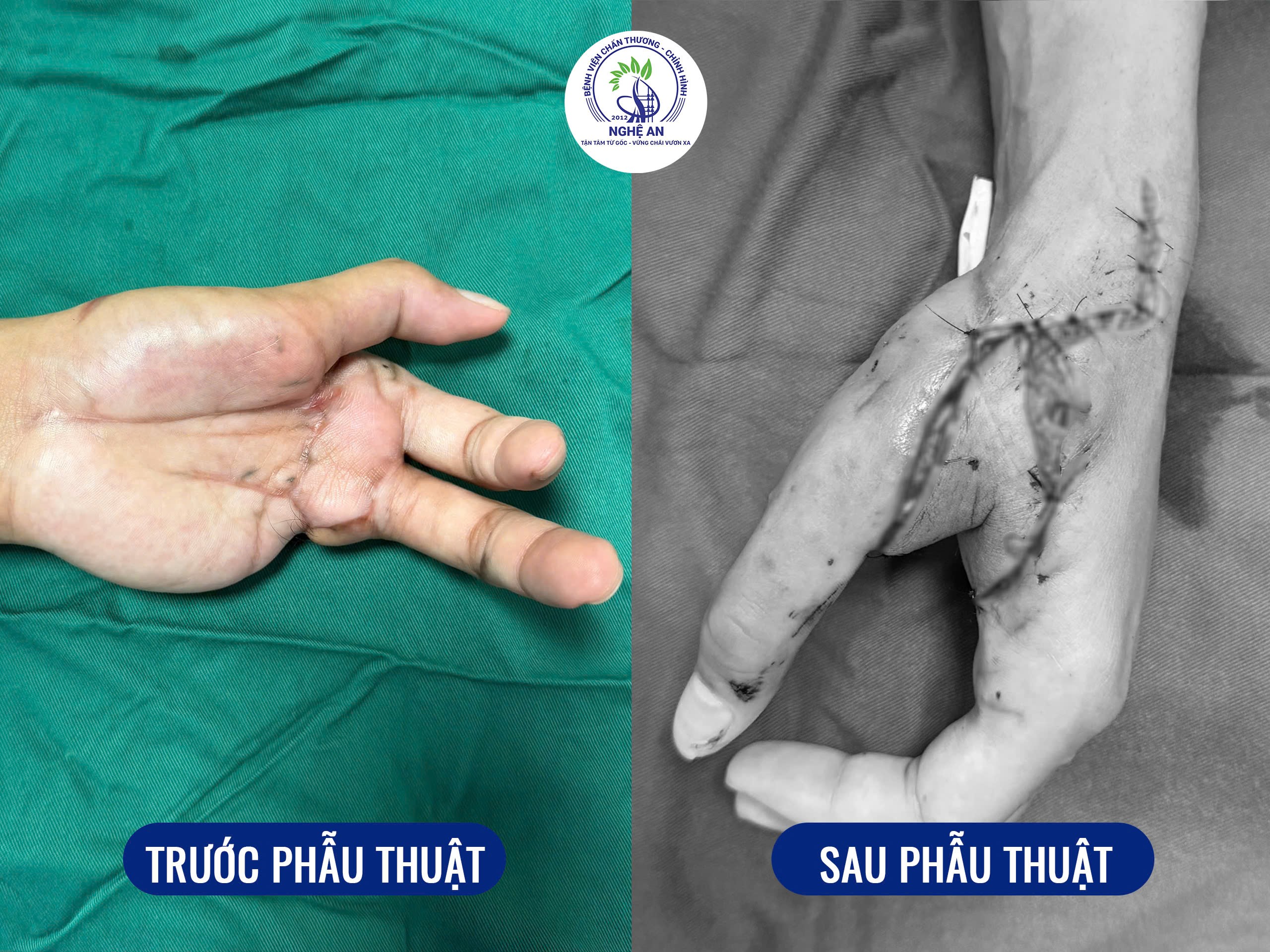 209-1781234792708310574449 Bước tiến trong phẫu thuật vi phẫu: Chuyển vạt SCIP tự do được triển khai tại Nghệ An- Ảnh 2.