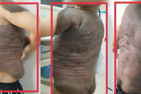 6 lần đại phẫu cắt bỏ khối u ‘mai rùa’ nặng trĩu trên lưng bé trai 7 tuổi