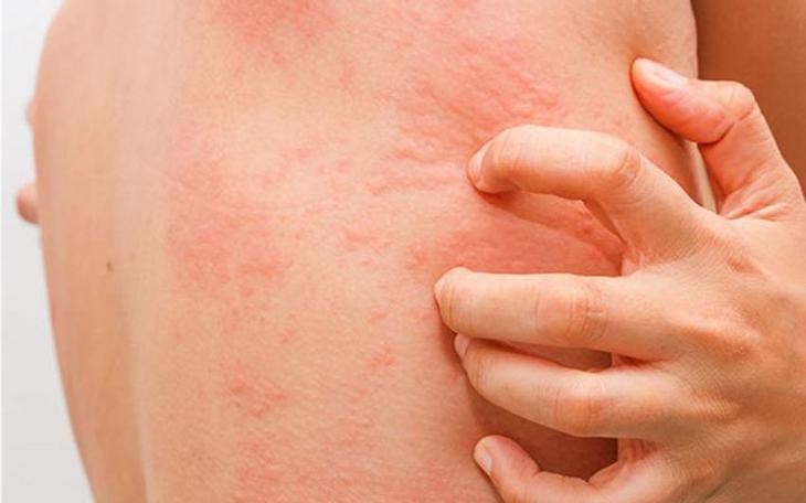 Nổi mề đay, đau nhức vùng nách rồi lan khắp cơ thể sau khi dùng lăn khử mùi 'hàng Nhật' xách tay- Ảnh 3.