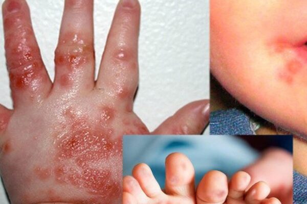 Lâm Đồng ghi nhận 2.265 ca mắc tay chân miệng, một ca tử vong do chủng EV71